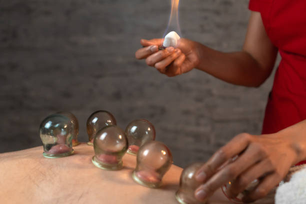 Massage therapist burns a stick inside a glass jar while giving vacuum therapy to a young man at a spa. Masseur puts glass jars on the man's back.